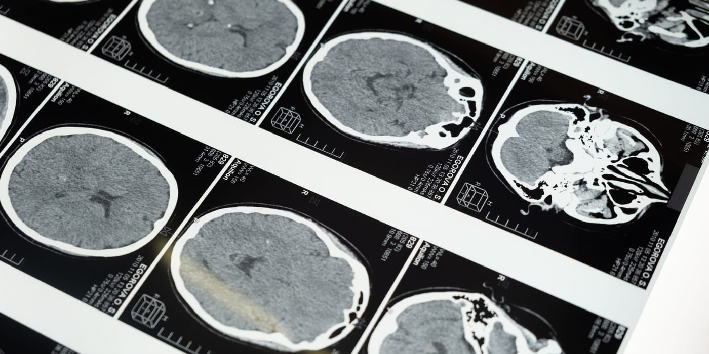Warning Signs of a Brain Tumor You Should Not Ignore