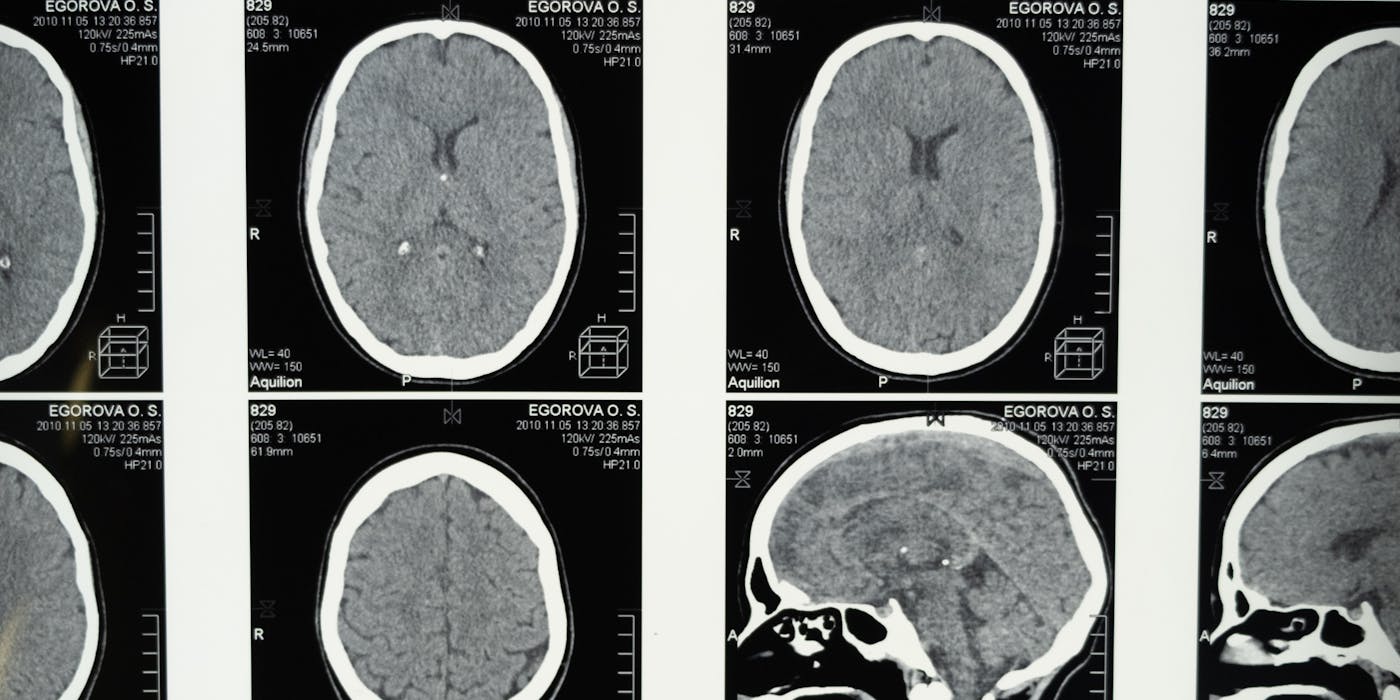 Slip Disc: When to Try Conservative Treatment vs Surgery